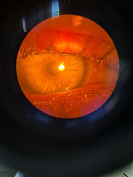 В минувшем году офтальмохирурги ГБУ РО «ОДКБ» выполнили 6 операций по кератопластике (трансплантации роговицы)